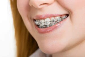 American Orthodontics in Landstuhl, Germany 